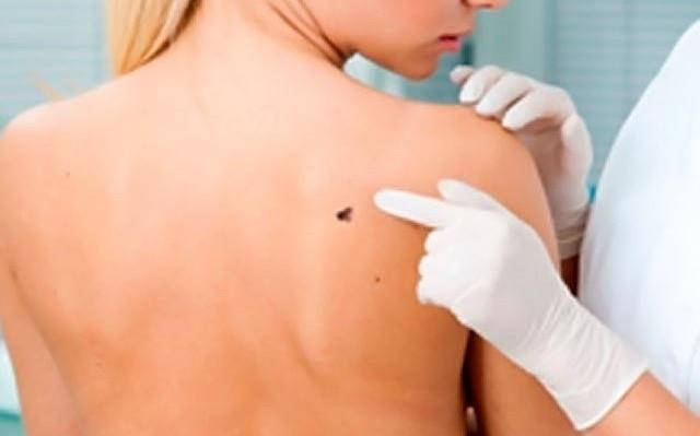 Αυξητική τάση καταγράφει ο καρκίνος του δέρματος και κυρίως τα μελανώματα